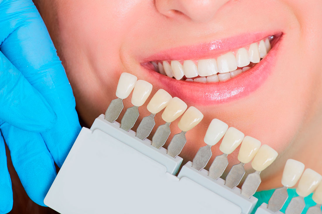 Estética dental Clínica dental en valencia