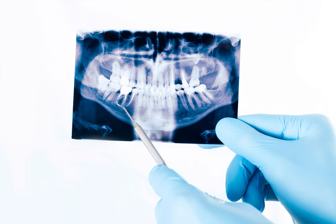 Extracción de muelas - Clínica dental en valencia
