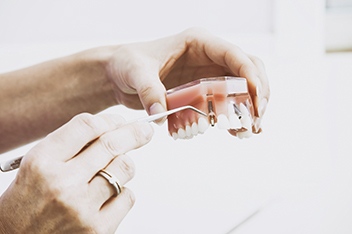Implantes dentales en Valencia Clínica dental en valencia