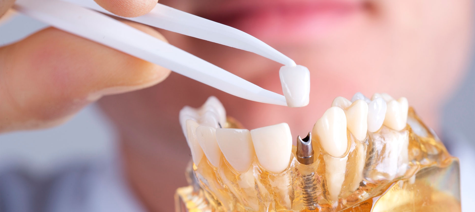 Implantes dentales en valencia
